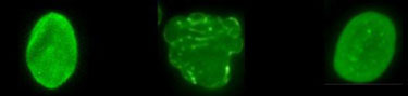 Normal cell, Progeria cell, Progeria cell after being treated with FTI