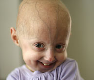 About Progeria The Progeria Research Foundation