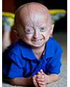 April 24, 2018: Global Study Published in JAMA Finds Treatment with Lonafarnib Extends Survival in Children with Progeria!