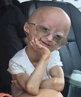 science behind Progeria The Progeria Research Foundation