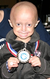 First-Ever Progeria Clinical Drug Trial Surpasses Half-Way Mark!