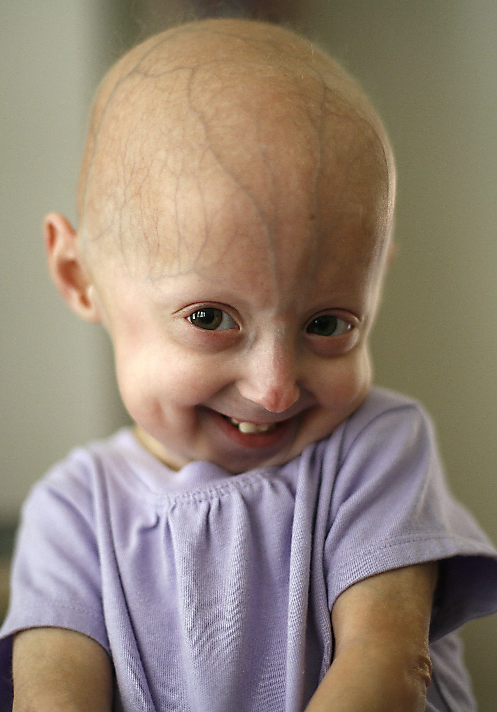 progeria research paper